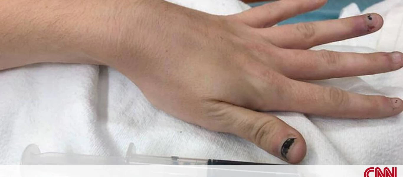 Απίστευτo: Γιατί το αίμα αυτής της γυναίκας είναι μπλε;